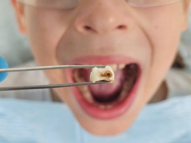 Best Emergency Wisdom Teeth Removal in St Bonaventure, NY